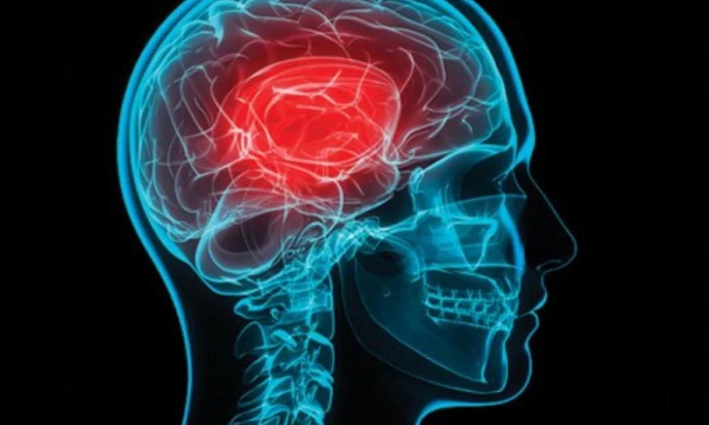 Κορονοϊός: Αυξάνει εμμέσως τον κίνδυνο για εγκεφαλικά επεισόδια